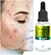 Sérum Facial Anti acne Bioativo 10 em 1  Maxlove 30 ml